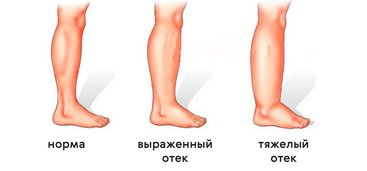 Как убрать отёки ног — домашние методы