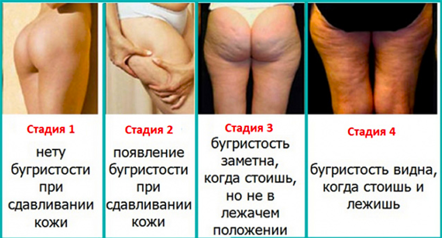 Стадии целлюлита